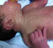 Защо мраморната кожа се появява в бебето?