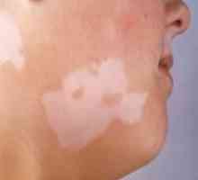 Защо се появяват светлинни петна по кожата?