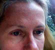 Защо кожата се люлее по лицето? Причини и лечение