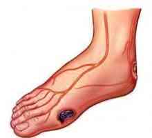 В детайли за това какво и как да се лекуват трофичните язви по краката