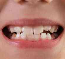 Мобилност на зъбите: степен, причини, лечение