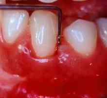 Последици от лоша хигиена: заболяване на венците