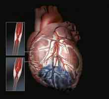 Постинфарктна кардиосклероза ICD 10