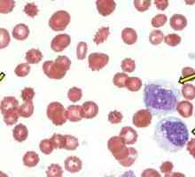 Повишени моноцити в кръвта - какво означава това?