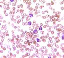 Повишени бели кръвни клетки в кръвта: какви са причините и какво е лечението?
