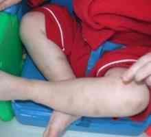 Повишени тромбоцити при детето: какви са причините?