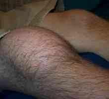 Предпаратичен бурсит на колянната става: симптоми и лечение