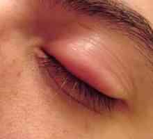 Причината за ечемика на окото: симптоматика и описание