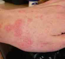 Причини за слънчева алергия и методи за лечение