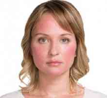 Причини за купероза по лицето и начини на лечение