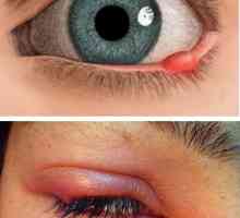 Причини за появата, симптомите и лечението на ечемика на окото при дете