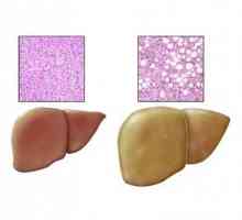 Причини, лечение и симптоми на чернодробна хепатоза в черния дроб