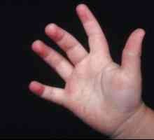 Знак за това кои заболявания е обрив при дете на краката и ръцете