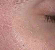 Pimple под око: причините за външния вид и как да се отървете от него?