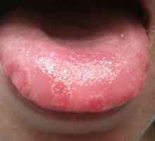 Пъпчица на езика: причини и лечение