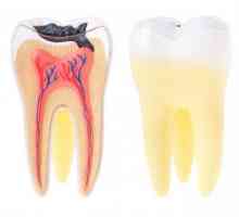Зъбът от камъни - какво е това? Пулпит при деца на млечни зъби: причини, симптоми и лечение