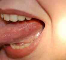 Рак на езика: етапи, снимки, признаци и симптоми
