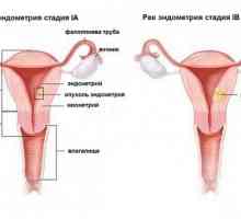 Рак на ендометриума на матката: симптоми, признаци, етапи, диагноза и лечение