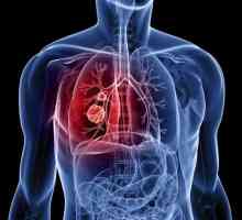 Рак на белия дроб: описание, причини, диагноза и терапевтични характеристики
