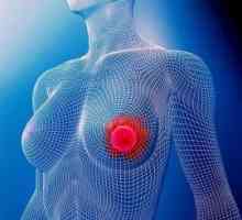 Рак на гърдата, етап 2а: прогноза. Ракът на гърдата лекува ли е в етап 2а?
