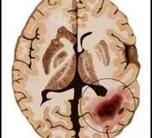Рак на мозъка: причини, симптоми и диагноза