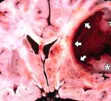 Рак на мозъка: симптоми, причини, диагноза, лечение, прогноза