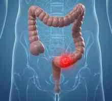 Рак на дебелото черво: симптом, етап, лечение, прогноза