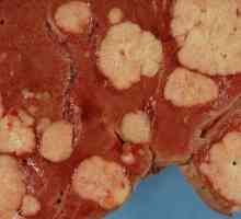 Рак на черния дроб: признаци на заболяването и всичко, което трябва да знаете за него