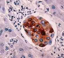 Рак на черния дроб: колко да живеем? Симптоми, причини и прогнози