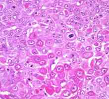 Сквамозен клетъчен карцином на шийката на матката: прогноза, лечение