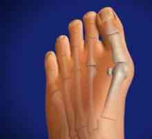 Отглеждане на костите на крака: причини, симптоми, лечение