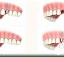 Възстановяване на зъба: кога и как да приложите процедурата?