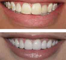 Възстановяване на зъбите: преди и след. Изкуството възстановяване на зъбите