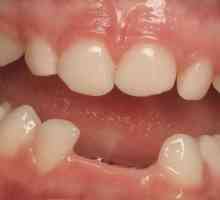 Задържането е това, което е в стоматологията?