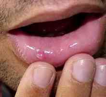 Задържаща киста на долната устна: причини, лечение