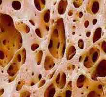 Резорбцията е унищожаването на костната тъкан: причините за патологията и методите за диагностика