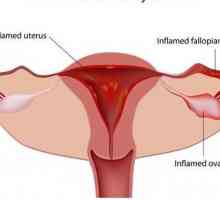 Салпингоофитит и бременност: какви са последствията? Salpingoophoritis - какво е това?…