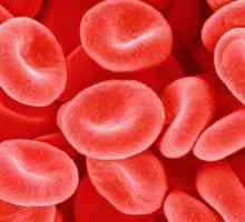 Сърповидно-клетъчна анемия: причини, симптоми и лечение