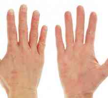 Кожа на ръцете: причини и лечение