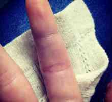 Тежко натъртване на пръста: лечение вкъщи