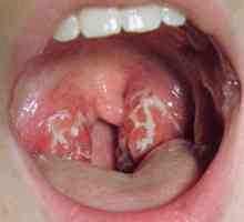 Симптоми на хроничен тонзилит, неговата превенция и лечение