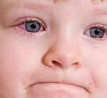 Симптоми и лечение на конюнктивит при деца