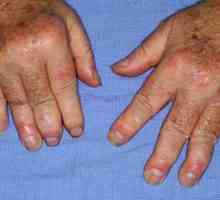 Симптоми и лечение на псориатичен артрит