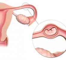 Симптомите на извънматочна бременност, причини и последици