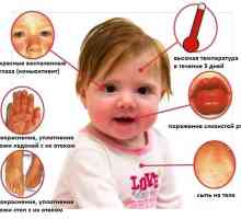 Синдром на Kawasaki при деца: причини и лечение