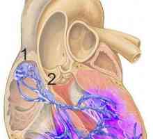 Синоатриална блокада: причини, лечение. Нарушения в ритъма на сърцето