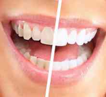 Система за избелване на зъбите Global White: отзиви. Global White: плюсовете и минусите