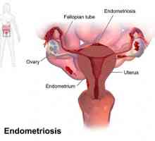 Спирала "Мирена" при ендометриоза: отговори