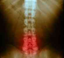 Спондилартроза на лумбалната част на гръбнака: причини, симптоми и лечение на болестта