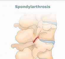 Спондилоартроза: причини и лечение. Спондилартроза на лумбосакралния гръбначен стълб